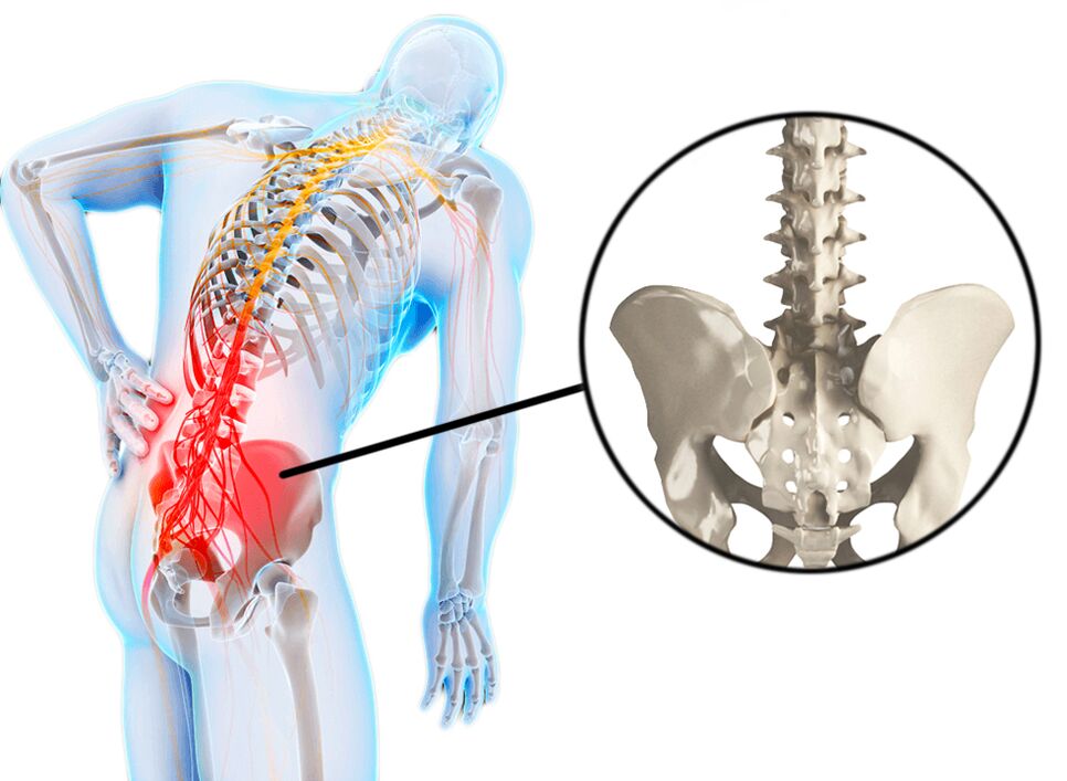 Le patologie spinali sono una causa comune di dolore lombare