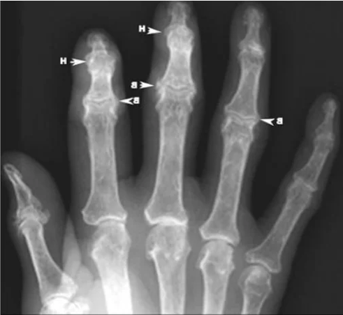 Osteofiti nell'osteoartrite delle articolazioni delle dita su una radiografia