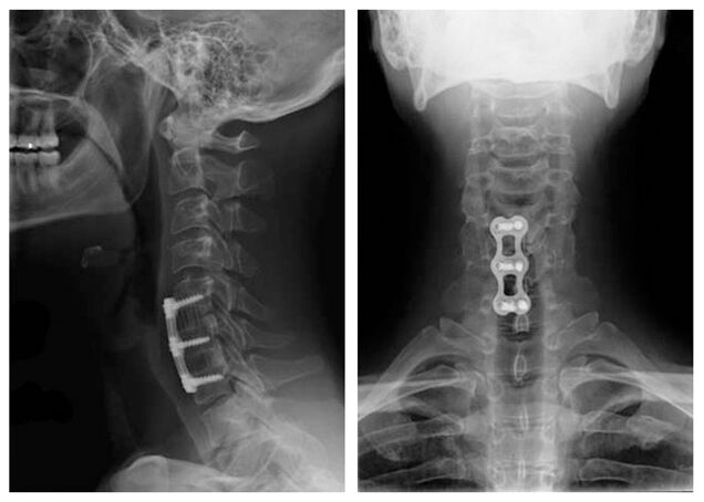 immagine dopo il trattamento delle vertebre