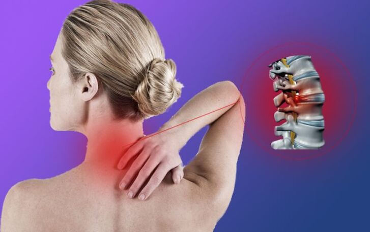 Infiammazione della colonna vertebrale con osteocondosi cervicale