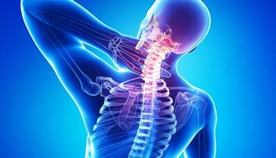 Complicanze dell'osteocondosi della colonna cervicale