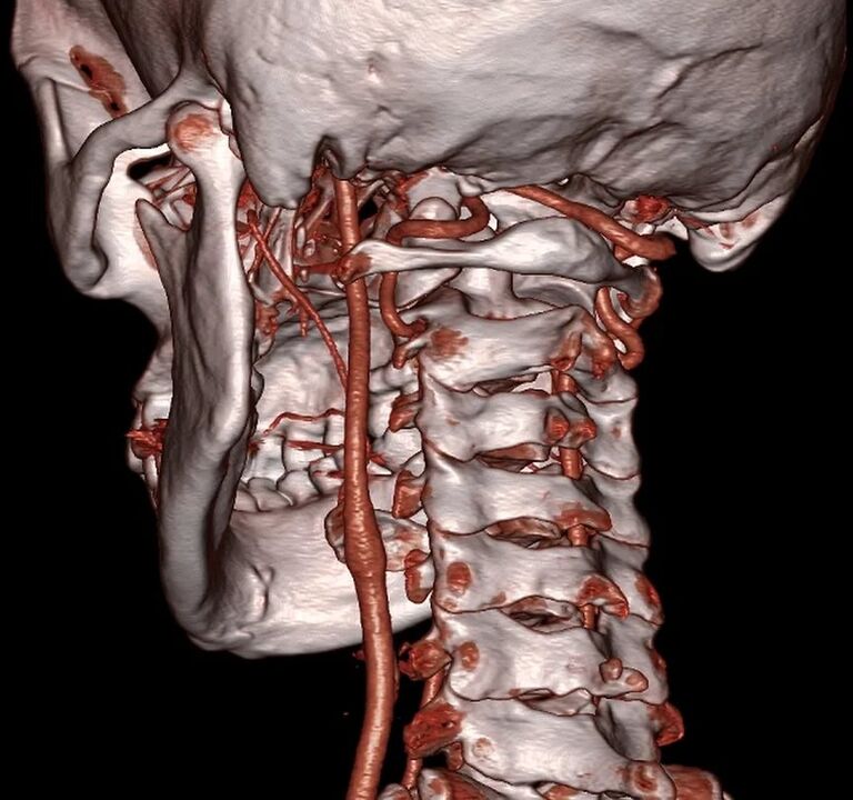 arteria pizzicata con osteocondrosi cervicale