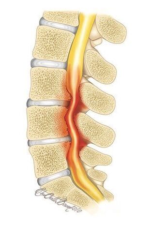 Con l'osteocondrosi della colonna vertebrale toracica, si verifica la compressione del canale spinale
