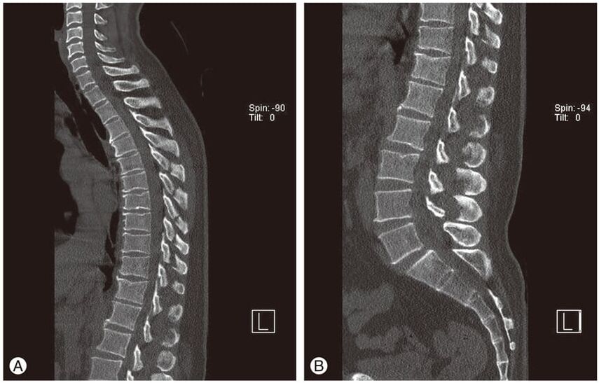 Deformazione dei dischi intervertebrali sulle immagini MRI nell'osteocondrosi toracica