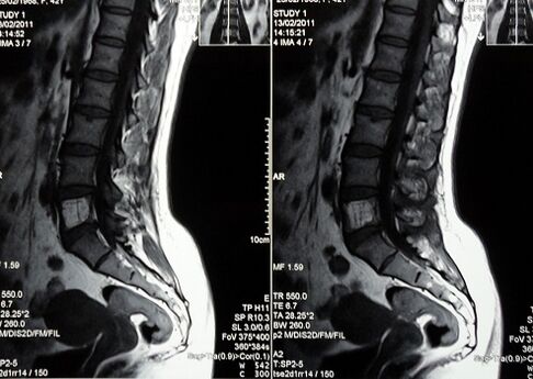 Risonanza magnetica della colonna lombosacrale per diagnosticare la lombalgia